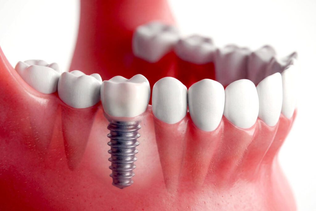 Cómo se coloca un implante dental