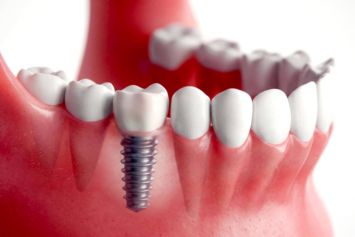Cómo se coloca un implante dental