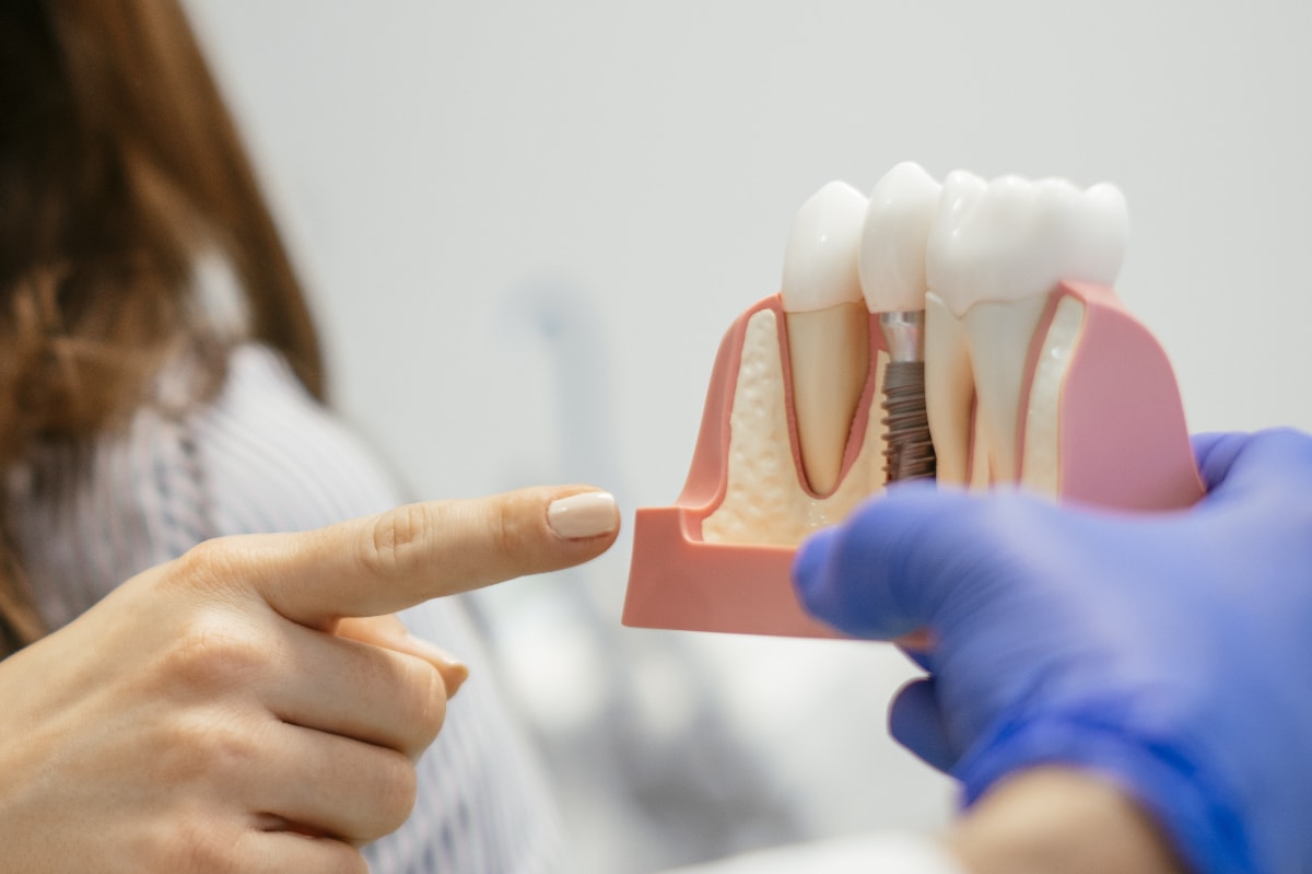 arreglr implantes dentales