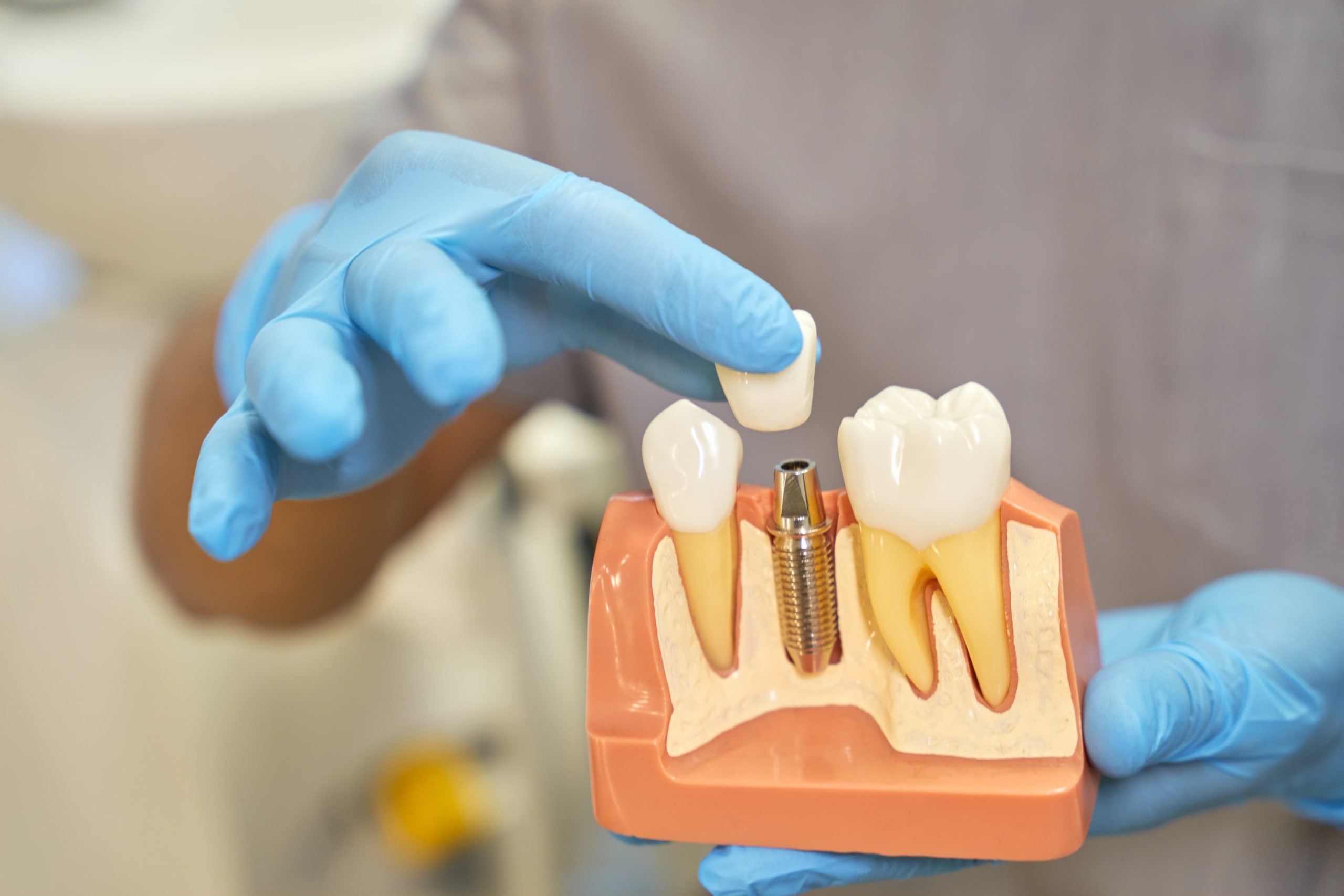 plazos para colocar implanes dentales